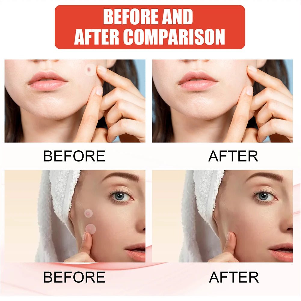 Hydrocolloid Acne Patch Invisible Closed Acne Patch Invisible Acne Face Invisible Waterproof Breathable Acne Skin Patch